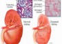 Hacia un mejor diagnóstico de la enfermedad renal
